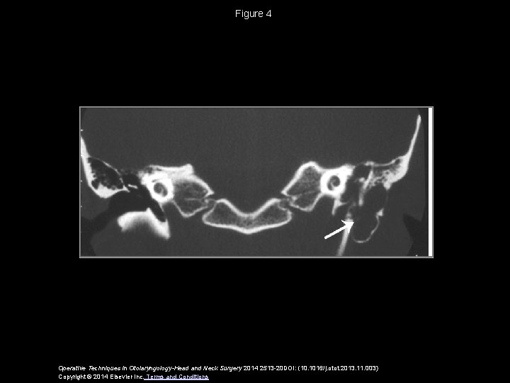 Figure 4 Operative Techniques in Otolaryngology-Head and Neck Surgery 2014 2513 -20 DOI: (10.