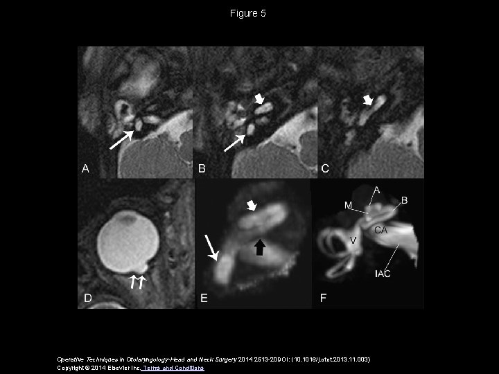 Figure 5 Operative Techniques in Otolaryngology-Head and Neck Surgery 2014 2513 -20 DOI: (10.