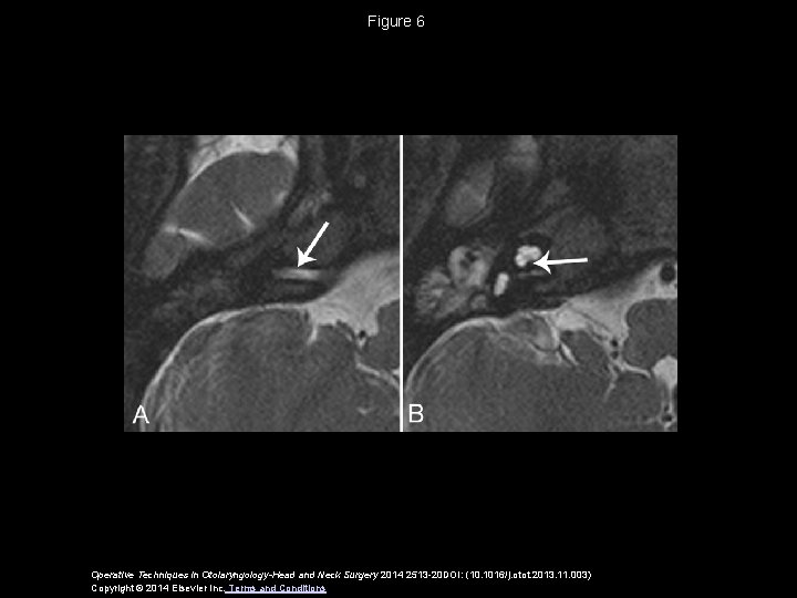 Figure 6 Operative Techniques in Otolaryngology-Head and Neck Surgery 2014 2513 -20 DOI: (10.