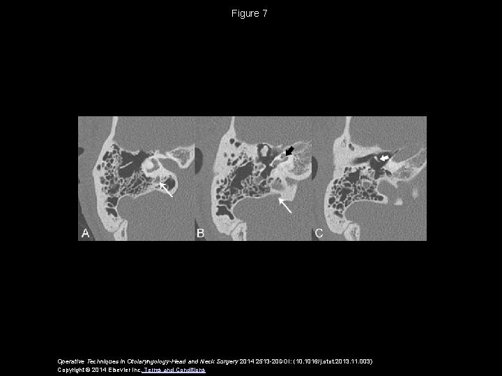 Figure 7 Operative Techniques in Otolaryngology-Head and Neck Surgery 2014 2513 -20 DOI: (10.