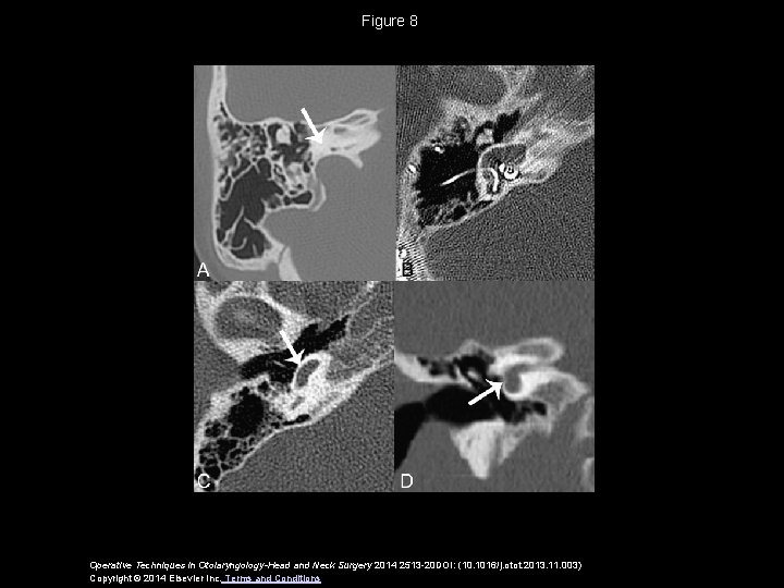 Figure 8 Operative Techniques in Otolaryngology-Head and Neck Surgery 2014 2513 -20 DOI: (10.