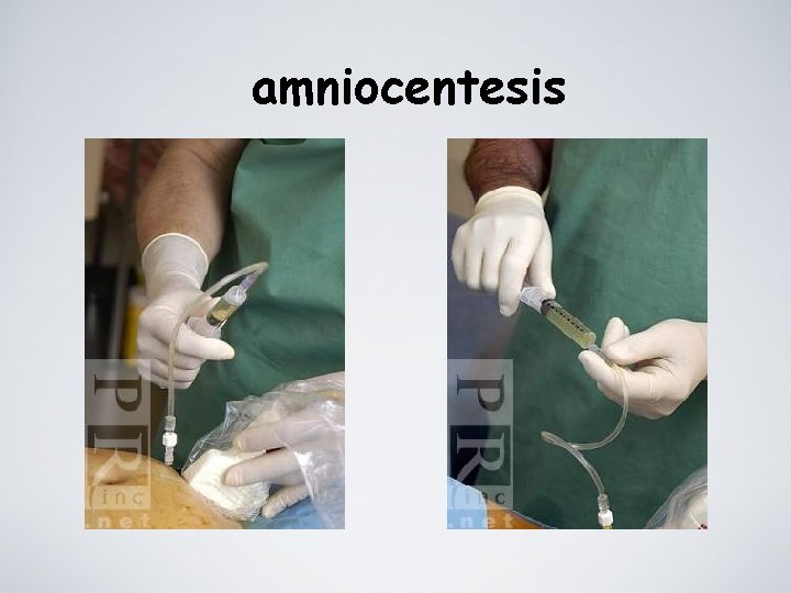 amniocentesis 
