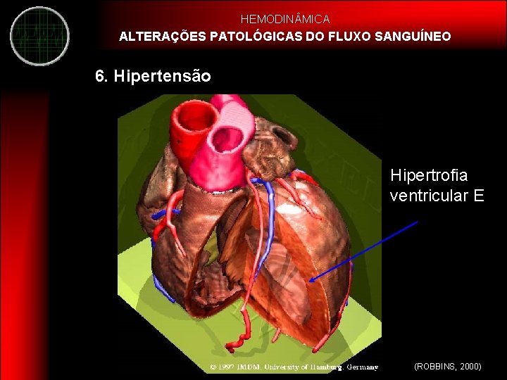 HEMODIN MICA ALTERAÇÕES PATOLÓGICAS DO FLUXO SANGUÍNEO 6. Hipertensão Hipertrofia ventricular E (ROBBINS, 2000)