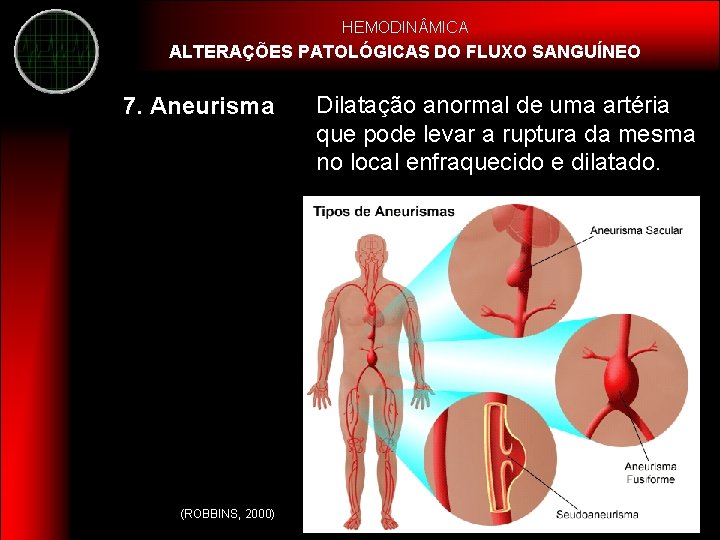 HEMODIN MICA ALTERAÇÕES PATOLÓGICAS DO FLUXO SANGUÍNEO 7. Aneurisma (ROBBINS, 2000) Dilatação anormal de