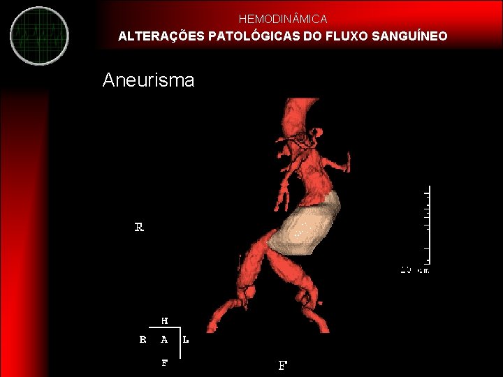 HEMODIN MICA ALTERAÇÕES PATOLÓGICAS DO FLUXO SANGUÍNEO Aneurisma 