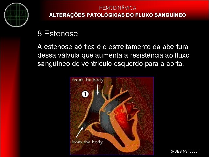 HEMODIN MICA ALTERAÇÕES PATOLÓGICAS DO FLUXO SANGUÍNEO 8. Estenose A estenose aórtica é o