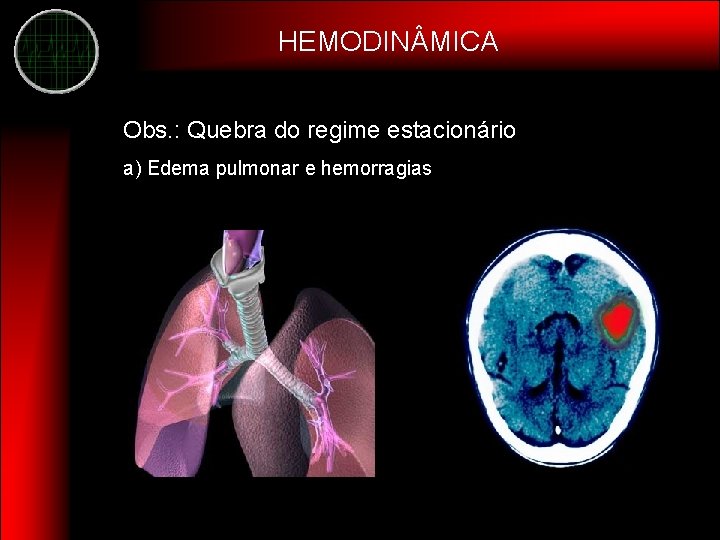 HEMODIN MICA Obs. : Quebra do regime estacionário a) Edema pulmonar e hemorragias 
