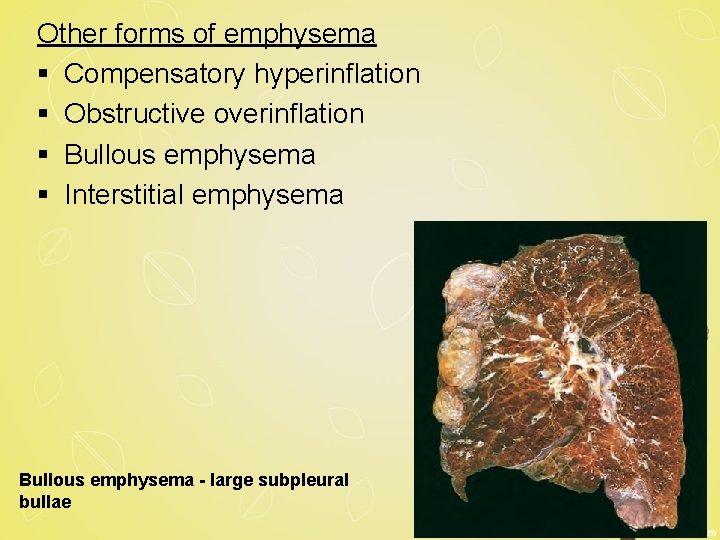 Other forms of emphysema § Compensatory hyperinflation § Obstructive overinflation § Bullous emphysema §