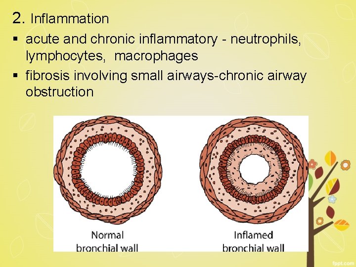 2. Inflammation § acute and chronic inflammatory - neutrophils, lymphocytes, macrophages § fibrosis involving