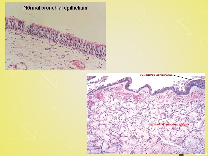 Normal bronchial epithelium 