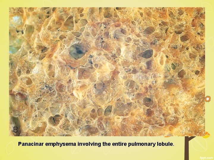 Panacinar emphysema involving the entire pulmonary lobule. 
