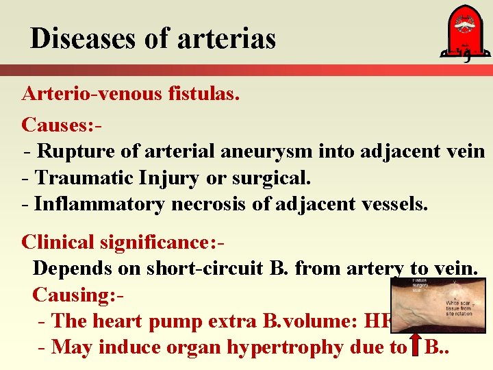 Diseases of arterias Arterio-venous fistulas. Causes: - Rupture of arterial aneurysm into adjacent vein