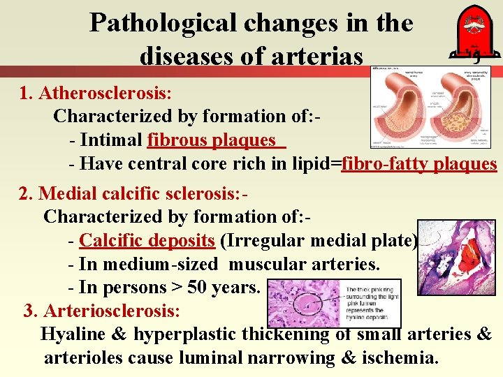 Pathological changes in the diseases of arterias 1. Atherosclerosis: Characterized by formation of: -