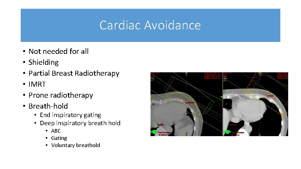 Cardiac Avoidance • • • Not needed for all Shielding Partial Breast Radiotherapy IMRT