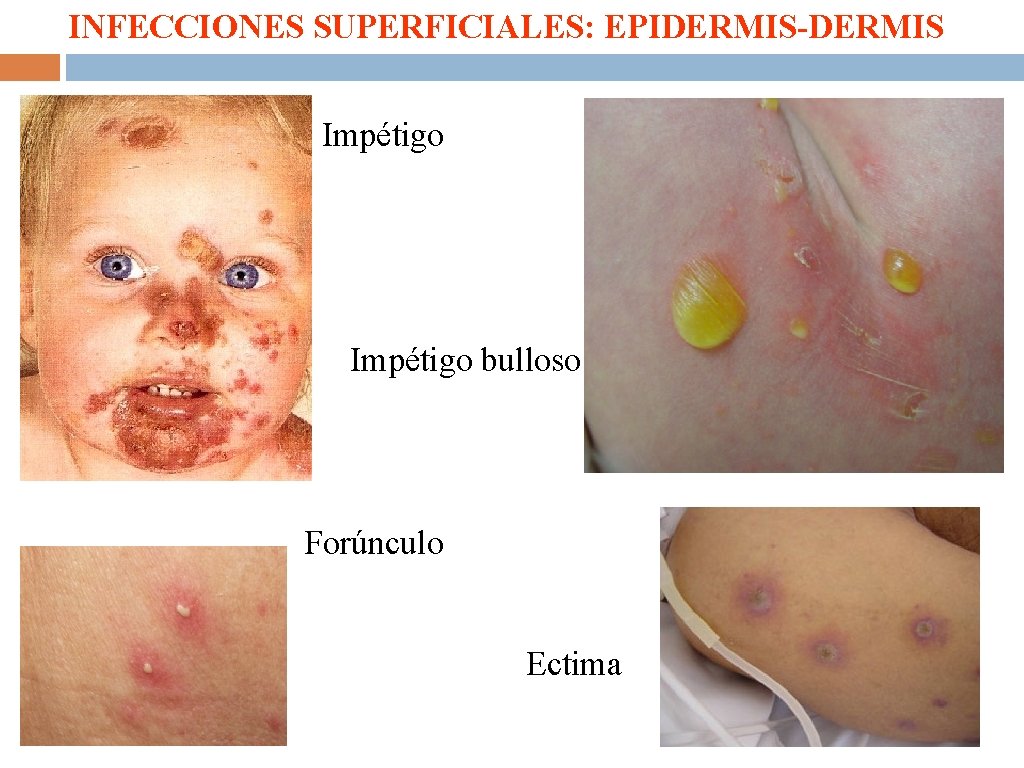 INFECCIONES SUPERFICIALES: EPIDERMIS-DERMIS Impétigo bulloso Forúnculo Ectima 
