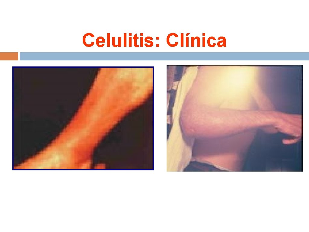 Celulitis: Clínica 