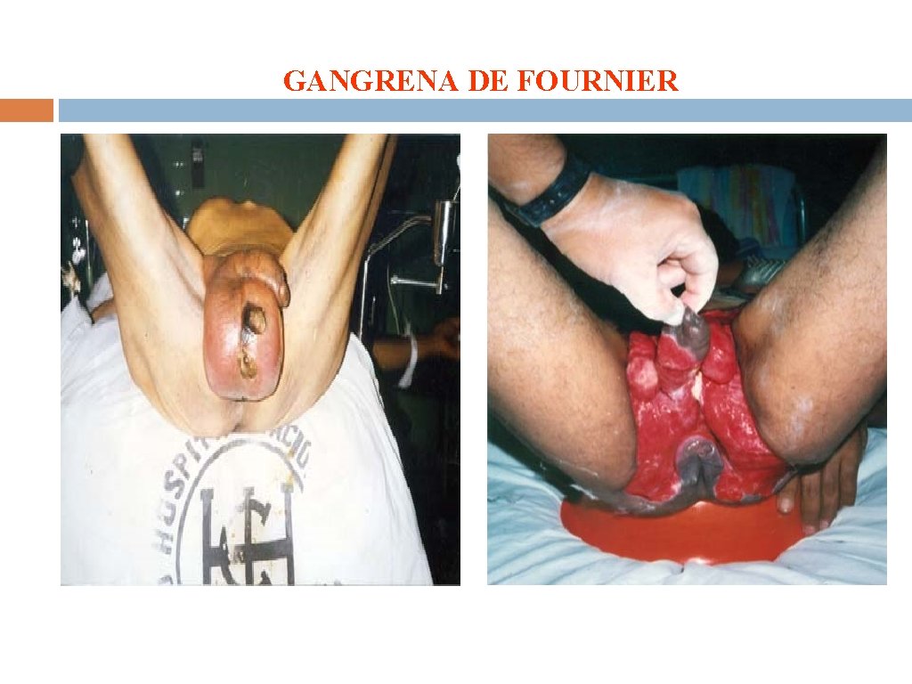 GANGRENA DE FOURNIER 