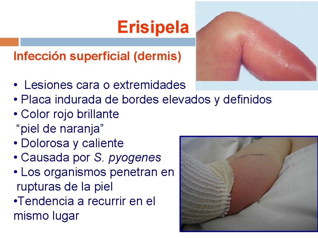 Erisipela Infección superficial (dermis) • Lesiones cara o extremidades • Placa indurada de bordes