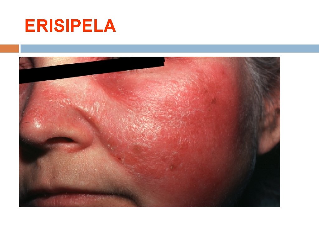 ERISIPELA 