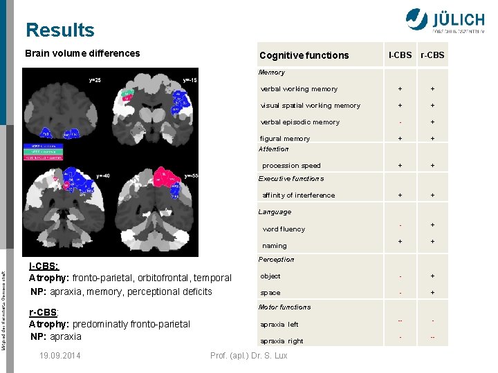 Results Brain volume differences Cognitive functions l-CBS r-CBS + + visual spatial working memory