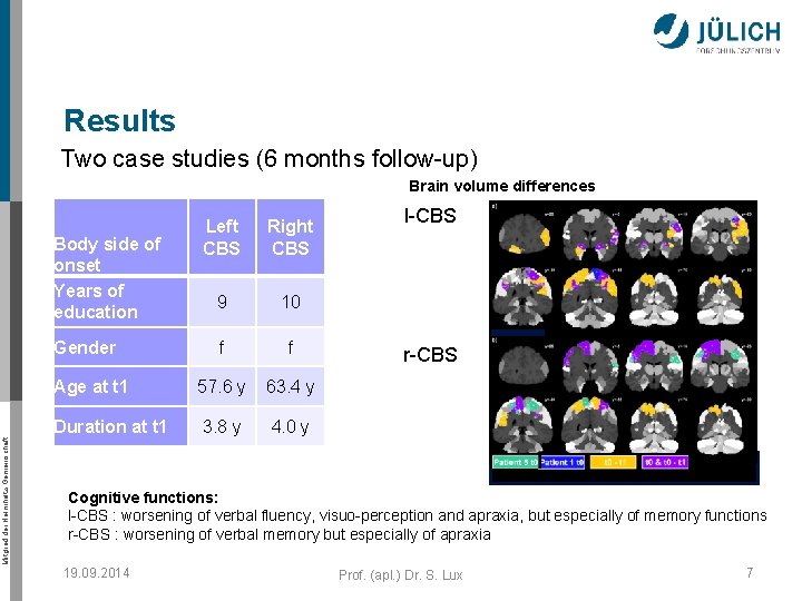 Results Two case studies (6 months follow-up) Brain volume differences Left CBS Right CBS