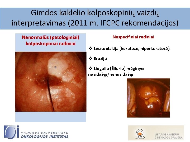 Gimdos kaklelio kolposkopinių vaizdų interpretavimas (2011 m. IFCPC rekomendacijos) Nenormalūs (patologiniai) kolposkopiniai radiniai Nespecifiniai