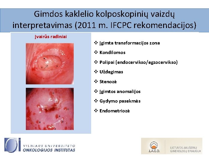 Gimdos kaklelio kolposkopinių vaizdų interpretavimas (2011 m. IFCPC rekomendacijos) Įvairūs radiniai v Įgimta transformacijos