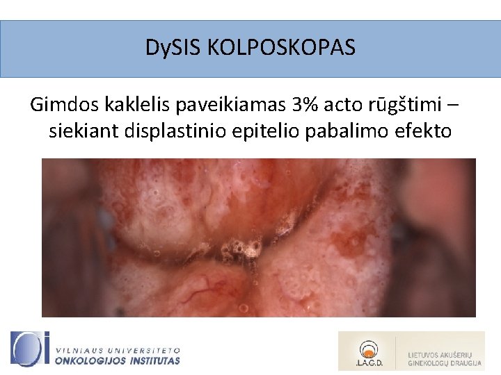 Dy. SIS KOLPOSKOPAS Gimdos kaklelis paveikiamas 3% acto rūgštimi – siekiant displastinio epitelio pabalimo