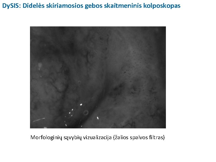 Dy. SIS: Didelės skiriamosios gebos skaitmeninis kolposkopas Morfologinių sąvybių vizualizacija (žalios spalvos filtras) 