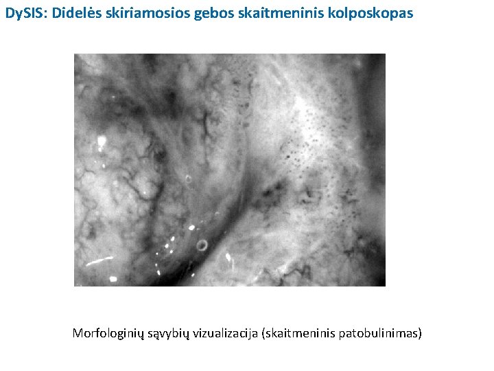 Dy. SIS: Didelės skiriamosios gebos skaitmeninis kolposkopas Morfologinių sąvybių vizualizacija (skaitmeninis patobulinimas) 