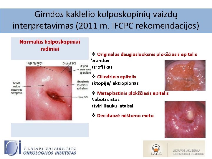 Gimdos kaklelio kolposkopinių vaizdų interpretavimas (2011 m. IFCPC rekomendacijos) Normalūs kolposkopiniai radiniai v Originalus