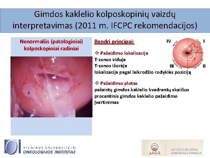 Gimdos kaklelio kolposkopinių vaizdų interpretavimas (2011 m. IFCPC rekomendacijos) Nenormalūs (patologiniai) kolposkopiniai radiniai Bendri