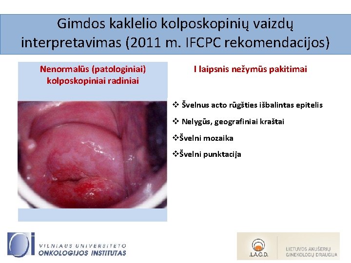 Gimdos kaklelio kolposkopinių vaizdų interpretavimas (2011 m. IFCPC rekomendacijos) Nenormalūs (patologiniai) kolposkopiniai radiniai I