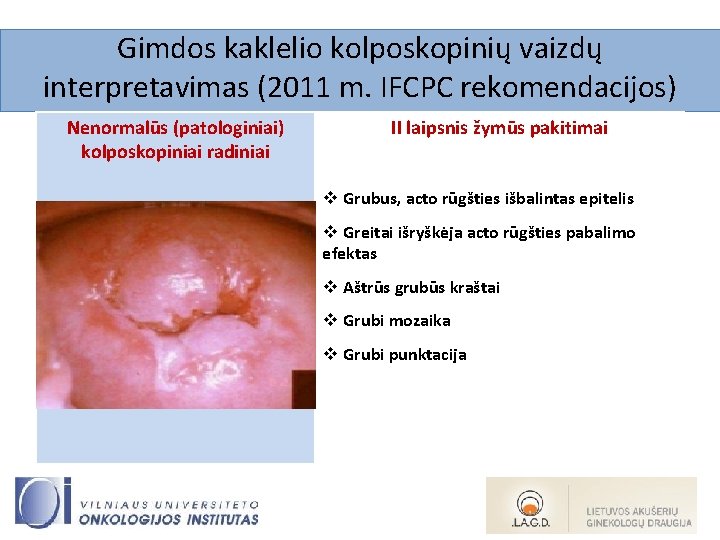 Gimdos kaklelio kolposkopinių vaizdų interpretavimas (2011 m. IFCPC rekomendacijos) Nenormalūs (patologiniai) kolposkopiniai radiniai II