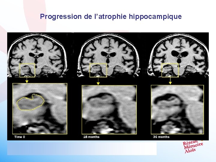 Progression de l’atrophie hippocampique 