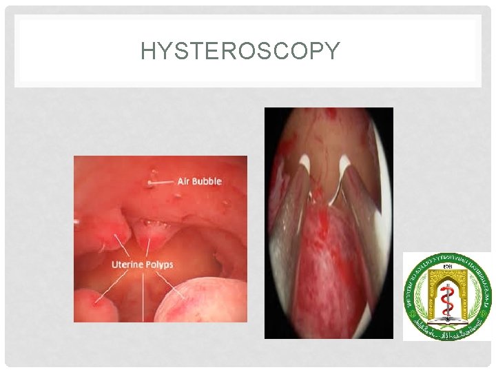 HYSTEROSCOPY 