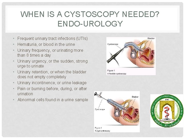 WHEN IS A CYSTOSCOPY NEEDED? ENDO-UROLOGY • Frequent urinary tract infections (UTIs) • Hematuria,