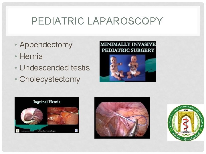 PEDIATRIC LAPAROSCOPY • Appendectomy • Hernia • Undescended testis • Cholecystectomy 