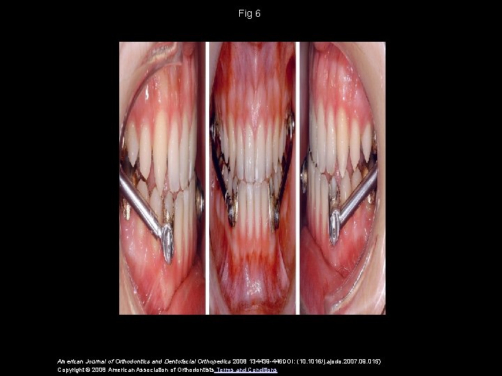 Fig 6 American Journal of Orthodontics and Dentofacial Orthopedics 2008 134439 -446 DOI: (10.