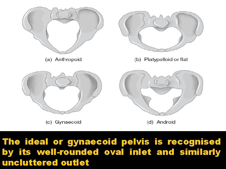 The ideal or gynaecoid pelvis is recognised by its well-rounded oval inlet and similarly