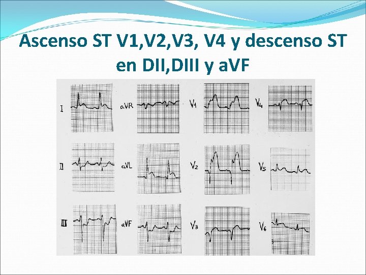 Ascenso ST V 1, V 2, V 3, V 4 y descenso ST en