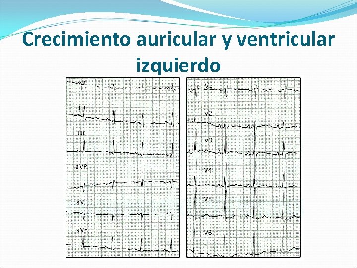 Crecimiento auricular y ventricular izquierdo 