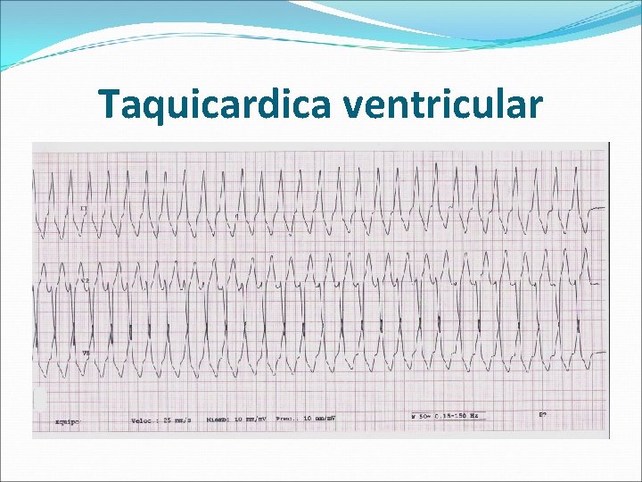 Taquicardica ventricular 
