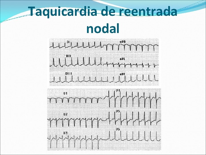 Taquicardia de reentrada nodal 