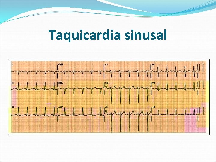 Taquicardia sinusal 