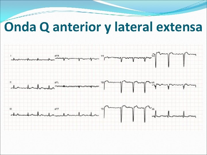 Onda Q anterior y lateral extensa 