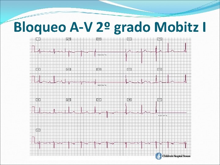 Bloqueo A-V 2º grado Mobitz I 