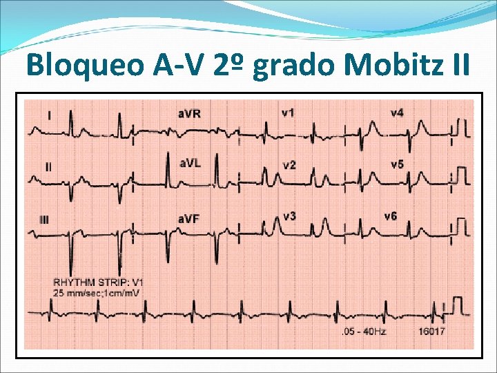 Bloqueo A-V 2º grado Mobitz II 