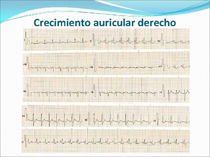 Crecimiento auricular derecho 