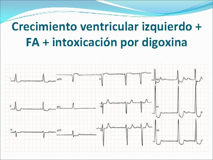 Crecimiento ventricular izquierdo + FA + intoxicación por digoxina 